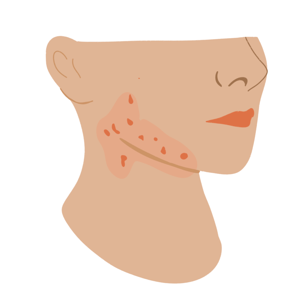 acné