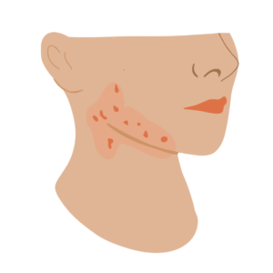 acné