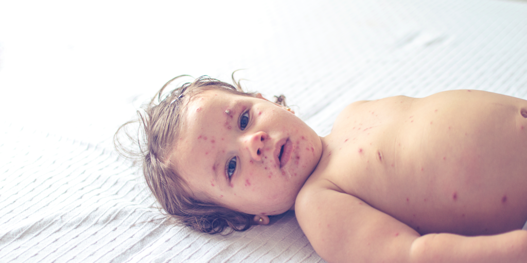bébé rougeole