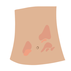 psoriasis