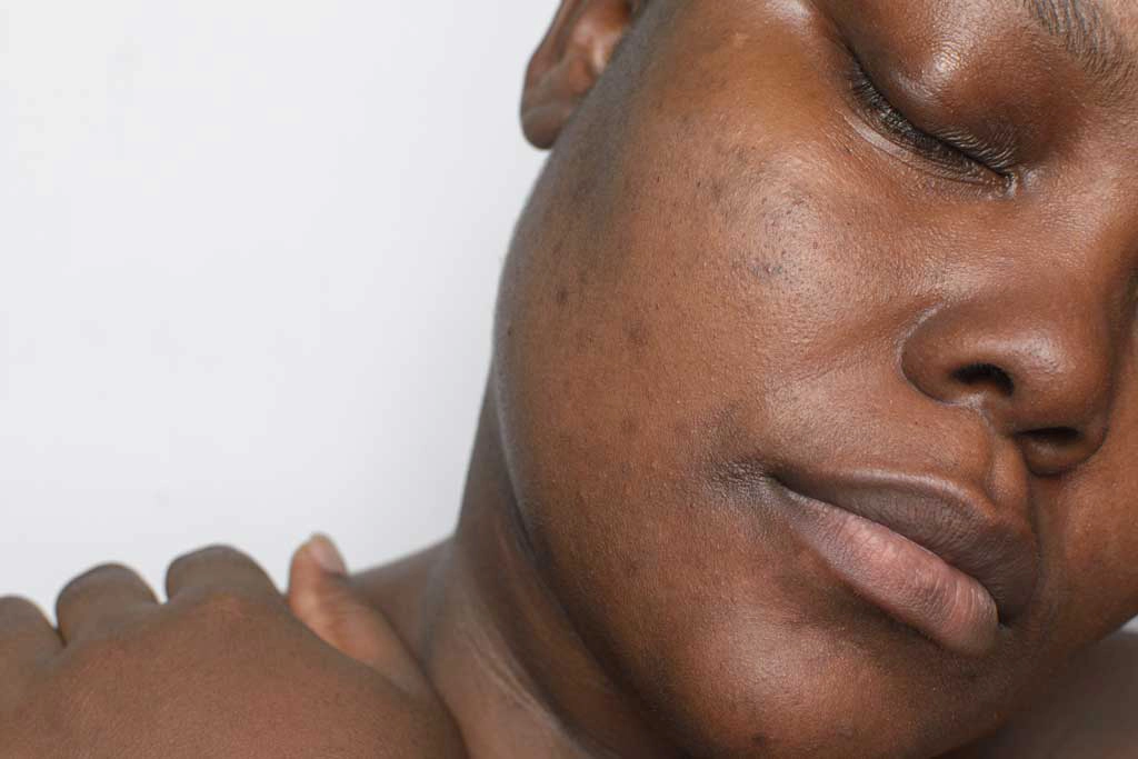 Hyperpigmentation
