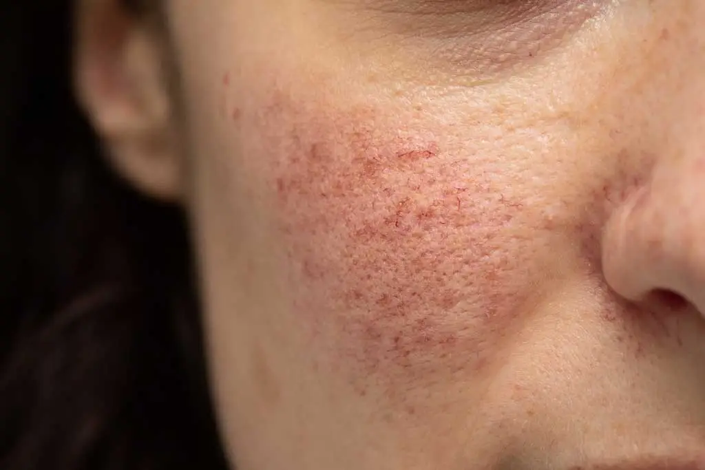 Photo-Principale-laser-vasculaire